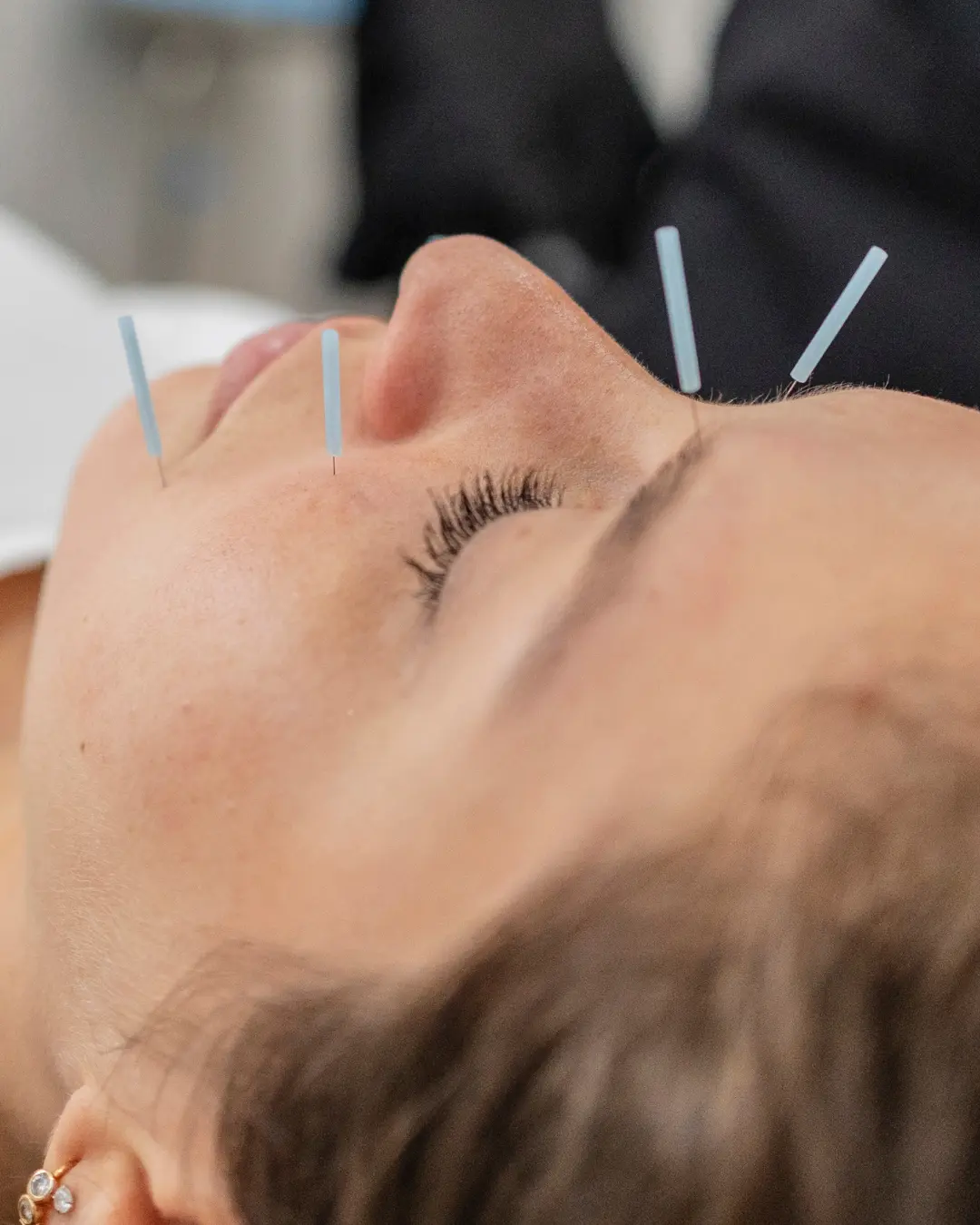 facial acupuncture markham
